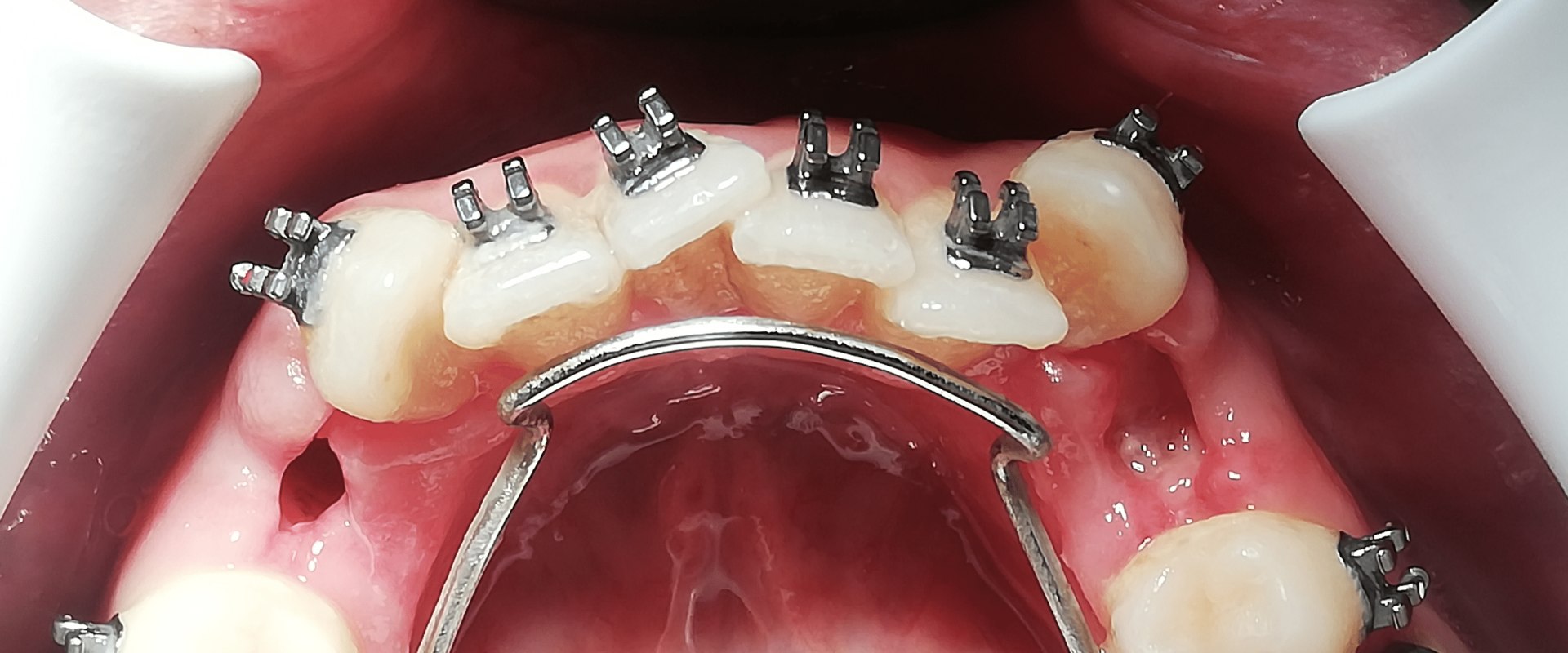 Do Antiseptic Gels Reduce the Risk of Infection After Dental Surgery?