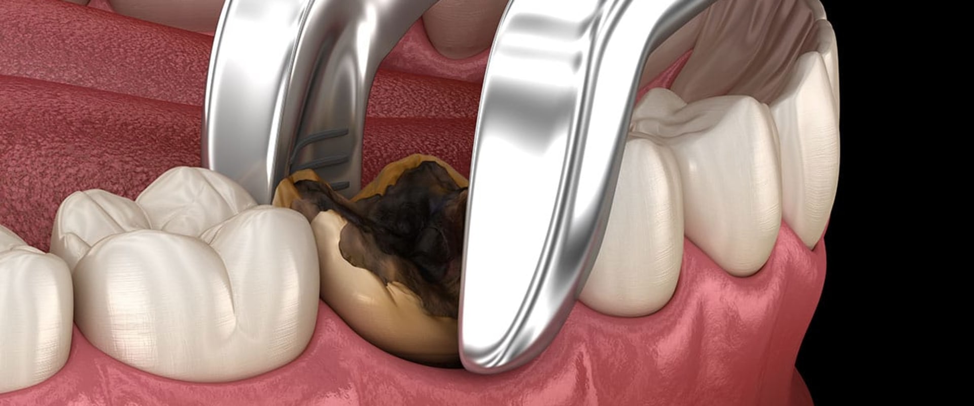 When Can I Take Painkillers After Oral Surgery?