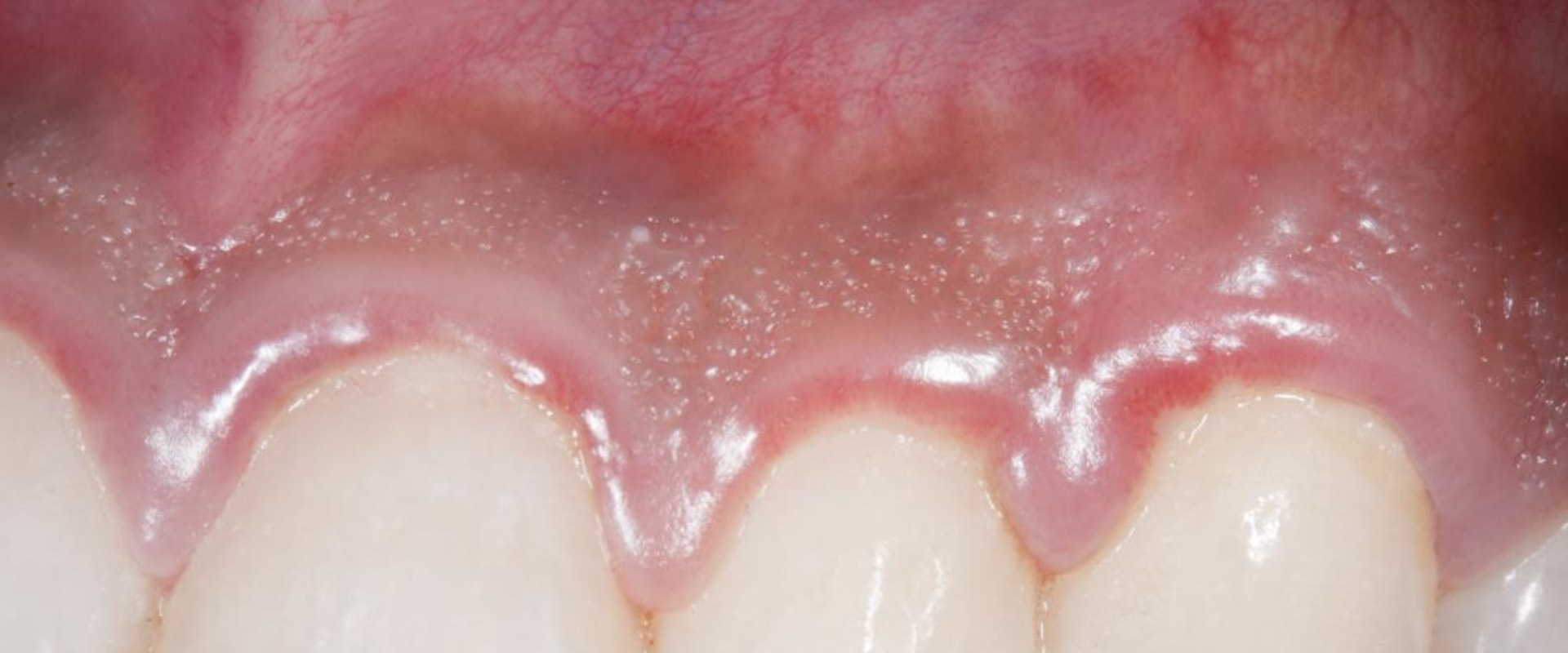 What Can I Do to Reduce Dental Swelling and Pain?