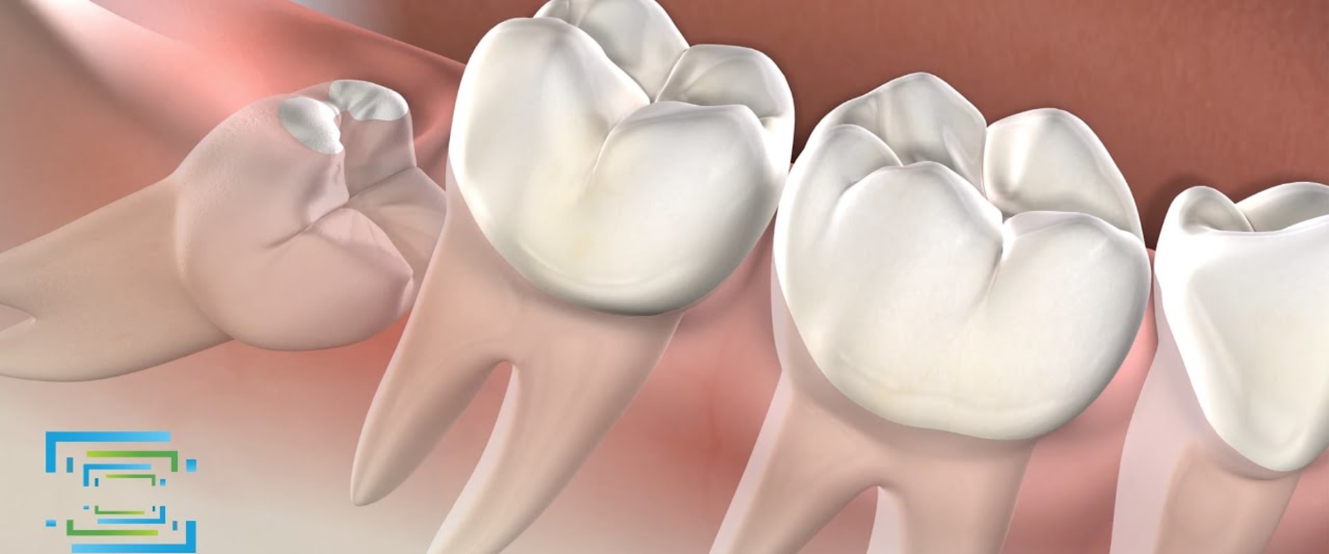 What to Eat After Oral Surgery with Stitches
