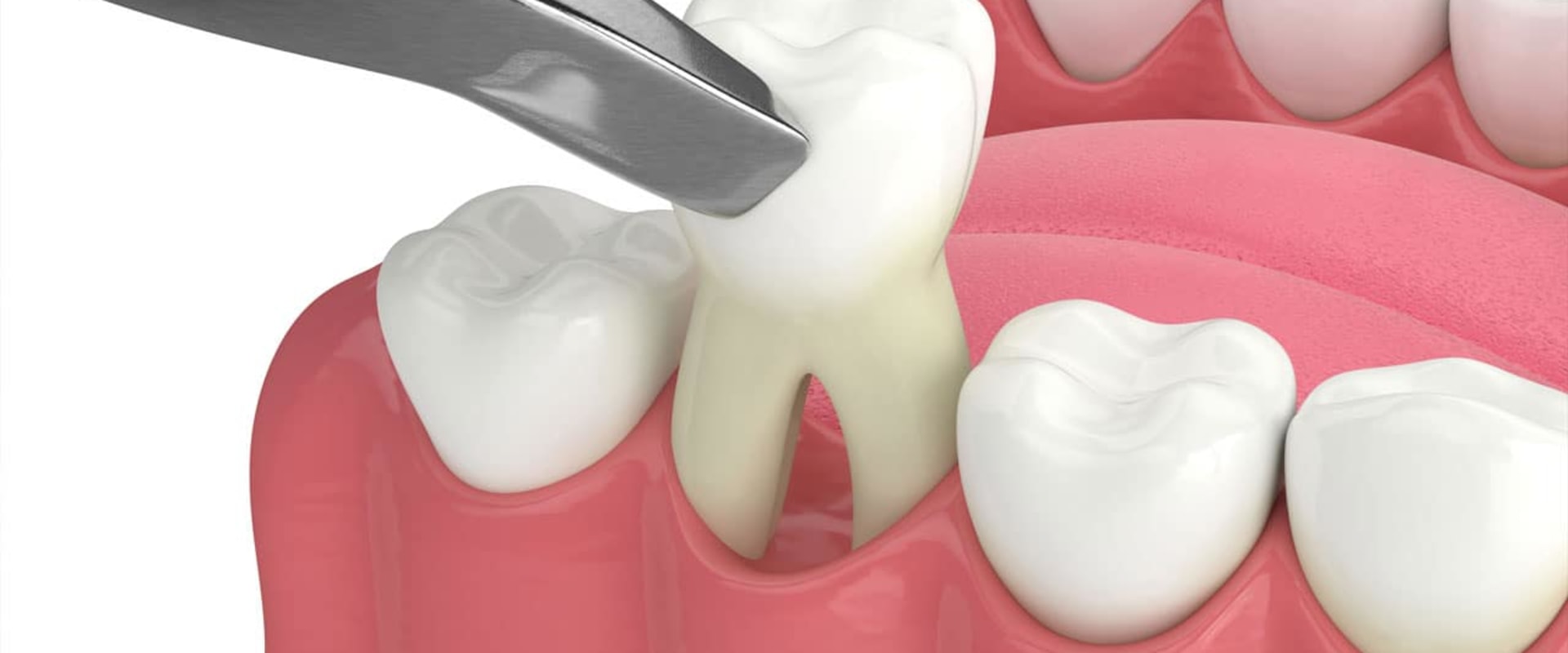 What to Do After a Dental Surgery Procedure