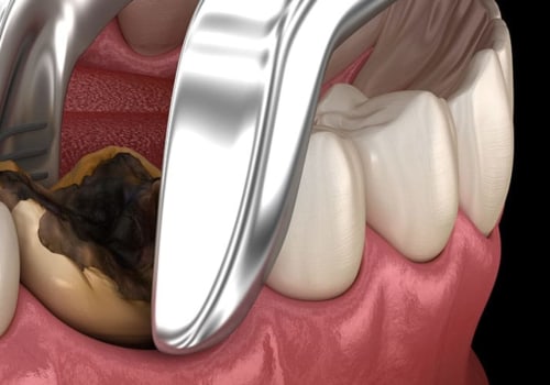 When Can I Take Painkillers After Oral Surgery?