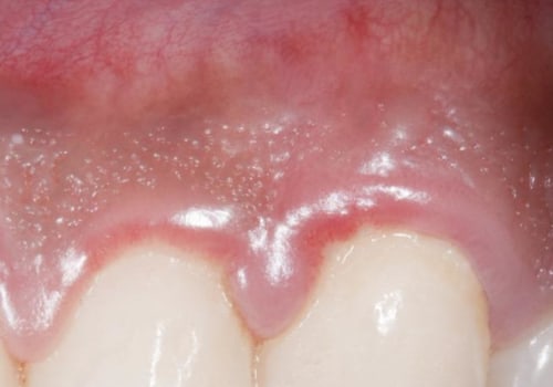 What Can I Do to Reduce Dental Swelling and Pain?