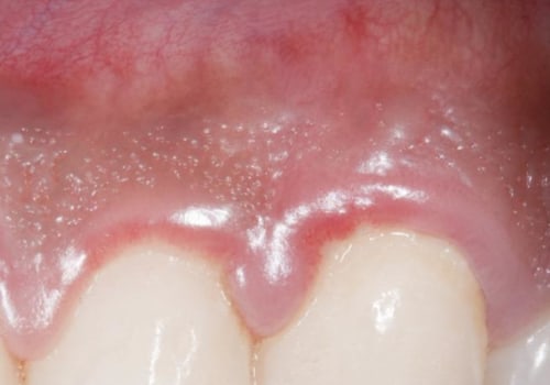 What Can I Do to Reduce Dental Swelling and Pain?